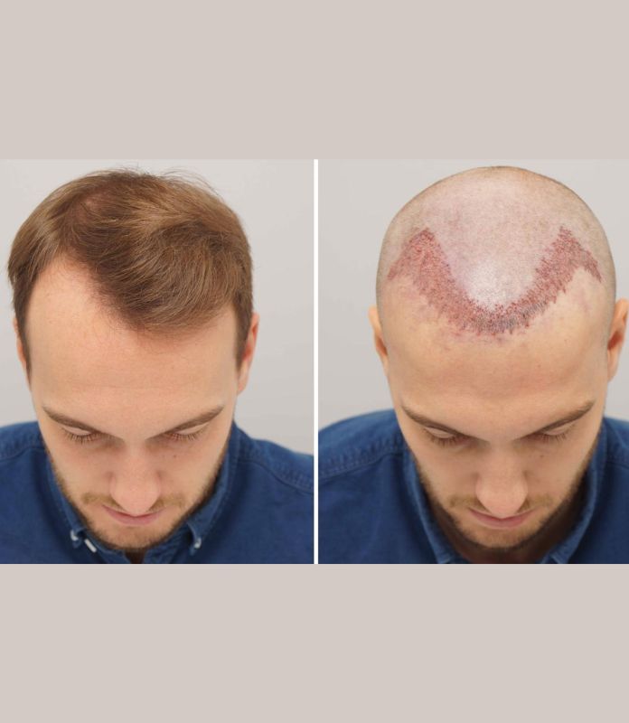 Hair Transplant